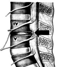 Picture X -Ray do Departamento Lombar de Osteocondrose