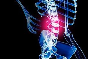 osteocondrose da coluna lombar