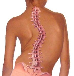 A curvatura da coluna leva à osteocondrose