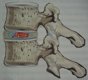 Primeiro estágio da osteocondrose