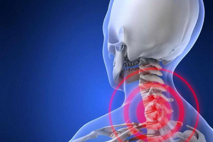 Dor aguda no pescoço é um sintoma precoce da osteocondrose cervical