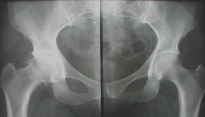 raio-x da articulação do quadril afetada com artrose